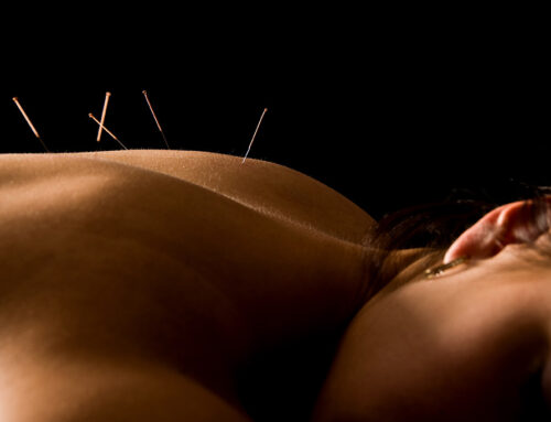 Can Acupuncture Help with Stress and Anxiety?